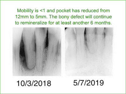teeth saved with Perioscopic