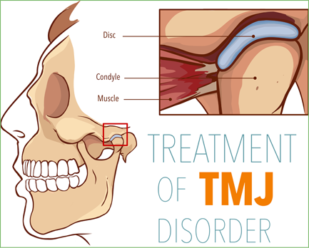 TMJ and facial pain yorba linda