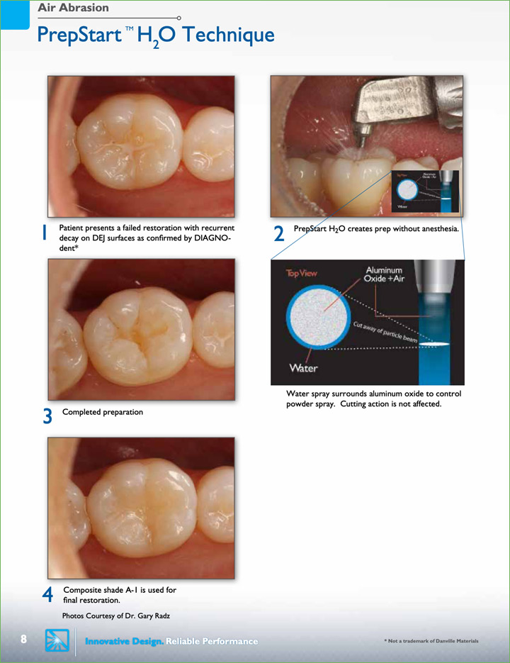 dental care without the drill yorba linda