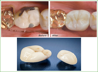 dental crowns yorba linda