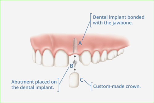 dental implants yorba linda