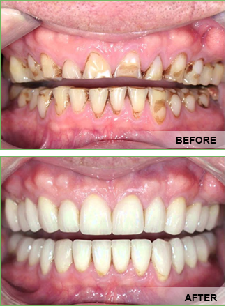 full mouth reconstruction yorba linda