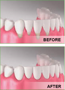 gum tissue graft yorba linda