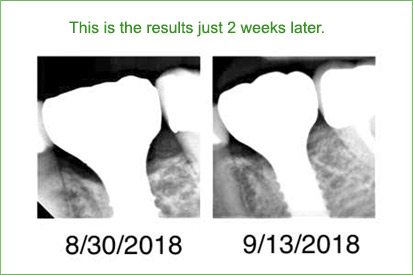 teeth saved with Perioscopic