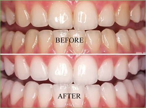 whiten teeth yorba linda