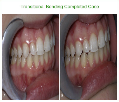 transitional bonding case