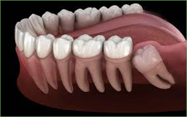 wisdom tooth extraction